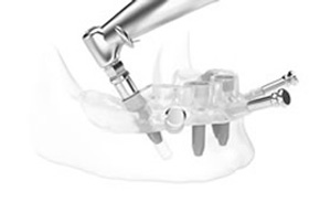 コンピューターガイドシステムによる治療