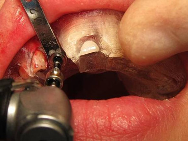 ガイドを使用した実際のインプラント埋入手術