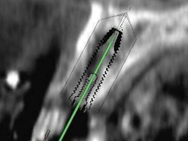 術前の３Dシミュレーション画像