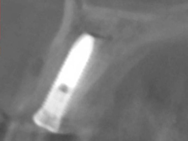 術前の３Dシミュレーション画像