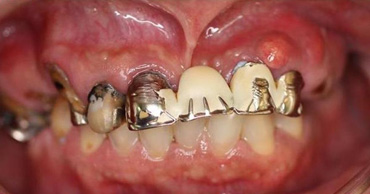 札幌東区　インプラント治療例Ⅱ-1