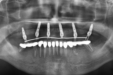 札幌東区　インプラント治療例Ⅱ-2
