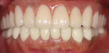 札幌東区　インプラント治療例Ⅱ-3