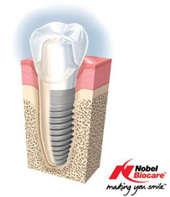 札幌東区　インプラント