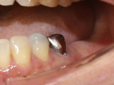 札幌東区　インプラント治療例Ⅱ-1