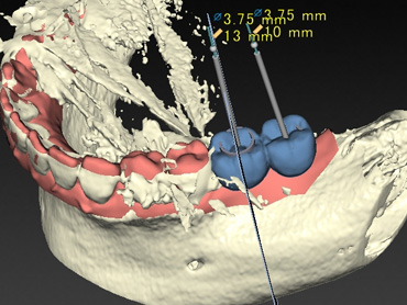 札幌東区　インプラント治療例Ⅱ-2