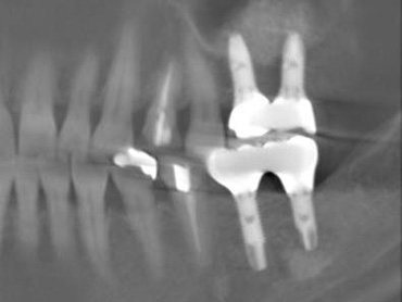 札幌東区　インプラント治療例Ⅱ-3