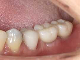 札幌東区　インプラント治療例Ⅱ-4