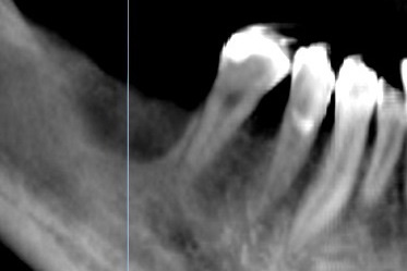 札幌東区　インプラント治療例Ⅱ-1