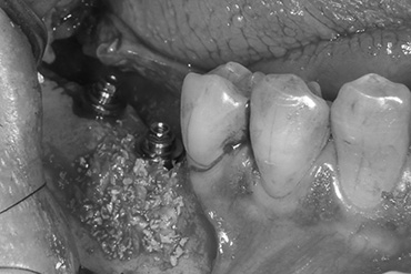 札幌東区　インプラント治療例Ⅱ-1