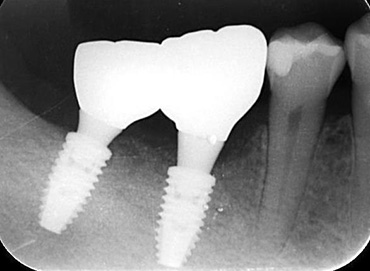 札幌東区　インプラント治療例Ⅱ-1