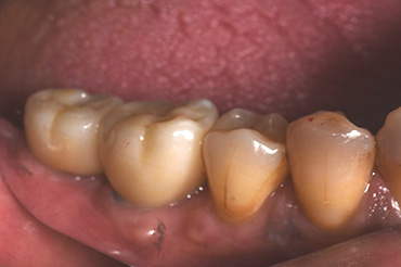 札幌東区　インプラント治療例Ⅱ-1