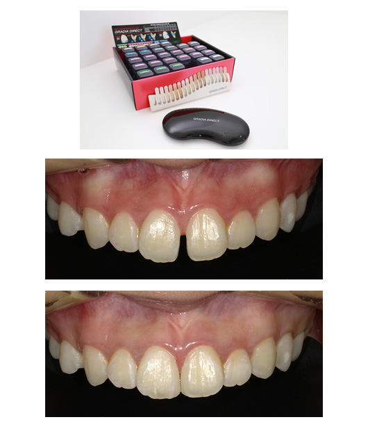 ダイレクトボンディング