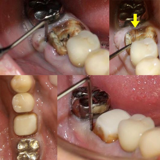 札幌東区　破折歯の接着修復