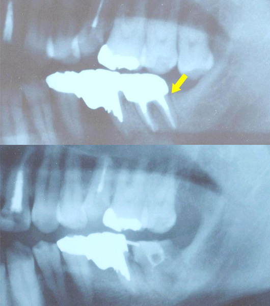 札幌東区　歯の移植・再植