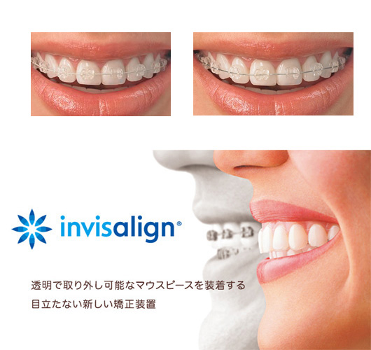 札幌東区　歯列矯正