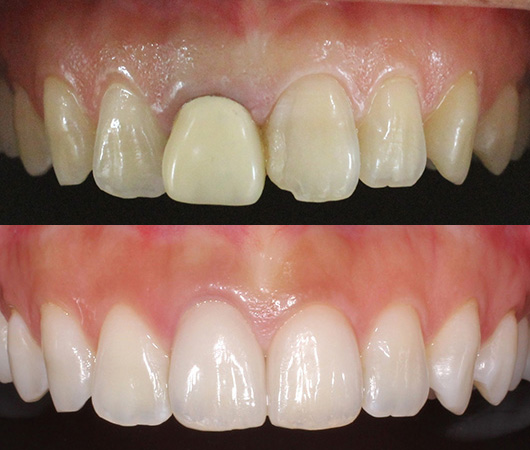 札幌東区　審美歯科