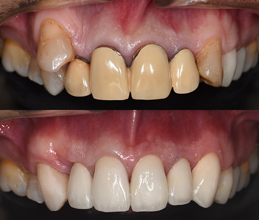 札幌東区　審美歯科